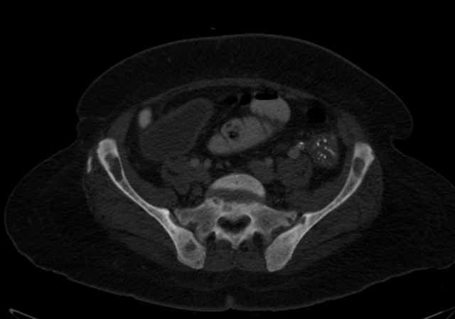 Brown tumors compressing the spinal cord (Radiopaedia 68442-77988 G 93).jpg