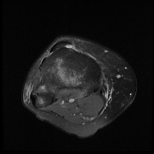 File:Bucket handle meniscus tear (Radiopaedia 56916-63751 Axial PD fat sat 18).jpg