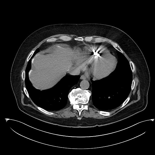 Buried bumper syndrome - gastrostomy tube (Radiopaedia 63843-72577 Axial Inject 8).jpg