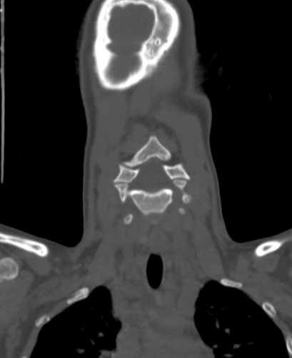 File:Butterfly vertebra (Radiopaedia 77903-90209 Coronal bone window 7).jpg