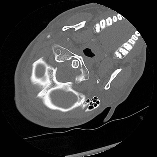 C1-C2 "subluxation" - normal cervical anatomy at maximum head rotation (Radiopaedia 42483-45607 Axial non-contrast 56).jpg