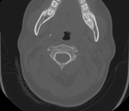 C7 laminar fracture and Klippel-Feil syndrome (Radiopaedia 86710-102850 Axial bone window 30).jpg