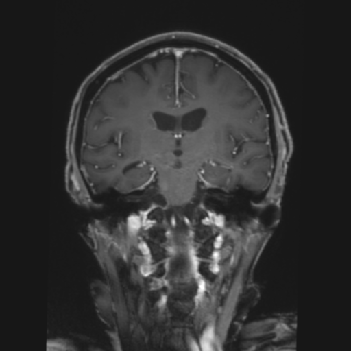 CNS lymphoma with steroid response (Radiopaedia 37980-39921 Coronal T1 C+ 24).png