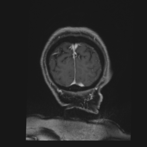File:CNS lymphoma with steroid response (Radiopaedia 37980-39921 Coronal T1 C+ 48).png