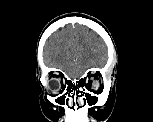Calcified cerebral hydatid cyst (Radiopaedia 65603-74717 C 12).jpg