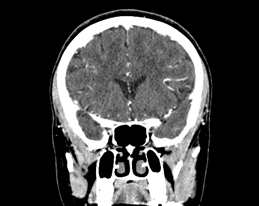 Calcified cerebral hydatid cyst (Radiopaedia 65603-74717 C 23).jpg