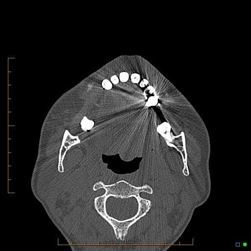 Calcified facial augmentation fillers (Radiopaedia 79514-92679 Axial bone window 104).jpg
