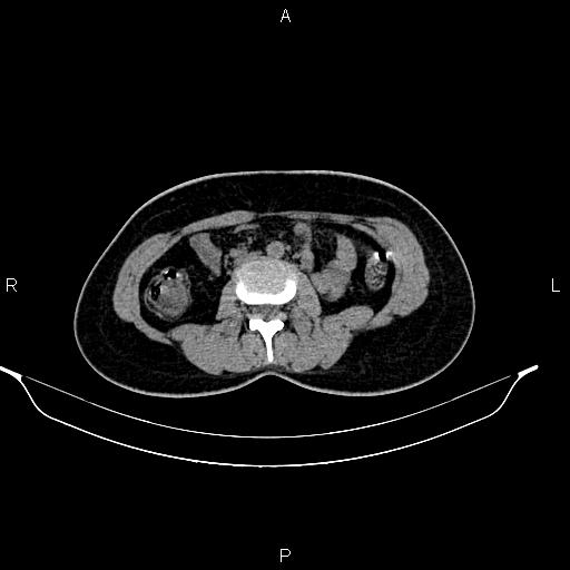 File:Calcified hepatic hydatid cyst (Radiopaedia 84672-100095 Axial non-contrast 58).jpg