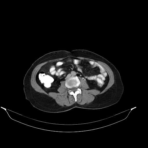 File:Calcified hydatid cyst of the liver (Radiopaedia 21212-21112 Axial C+ delayed 31).jpg