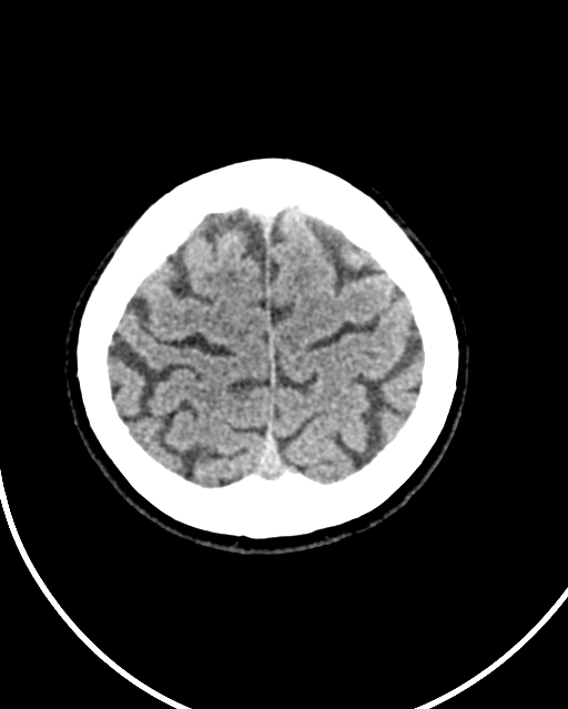Calcified meningioma (Radiopaedia 74361-85243 Axial non-contrast 9).jpg