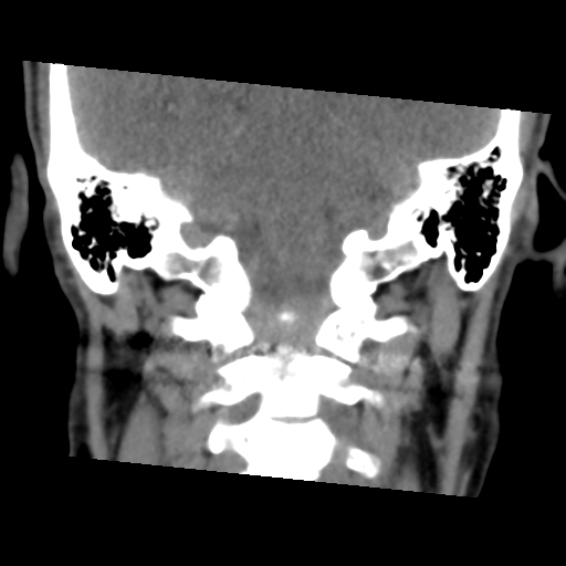 Calcifying pseudoneoplasm of neuraxis (Radiopaedia 44076-47617 Coronal non-contrast 28).png