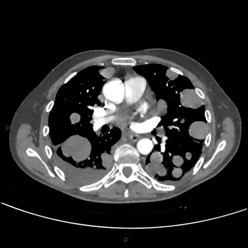 Cannonball metastases (Radiopaedia 82110-96150 Axial C+ CTPA 168).jpg
