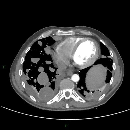 File:Cannonball metastases (Radiopaedia 82110-96150 Axial C+ CTPA 231).jpg