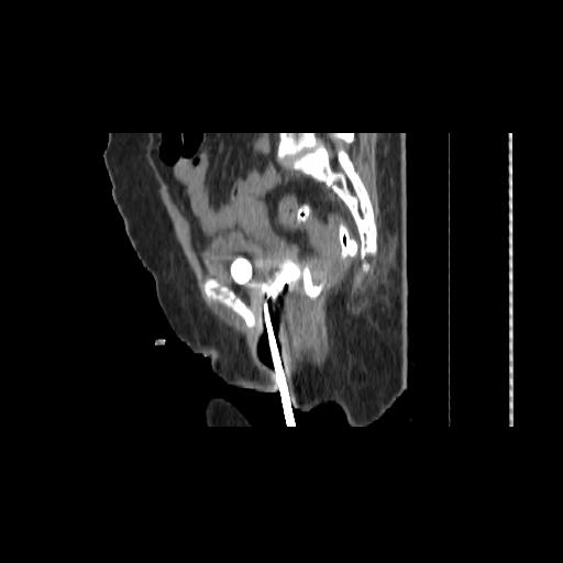 Carcinoma cervix- brachytherapy applicator (Radiopaedia 33135-34173 D 105).jpg
