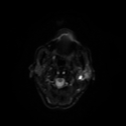 Carcinoma ex-pleomorphic adenoma of parotid (Radiopaedia 28383-28627 Ax DWI B-500 GE 17).jpg