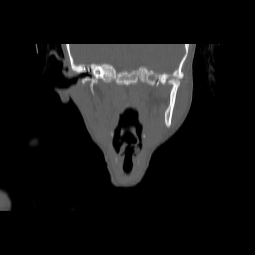 Carcinoma of the maxillary antrum (Radiopaedia 53805-59888 Coronal bone window 83).jpg