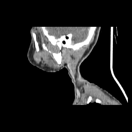 Carcinoma of the maxillary antrum (Radiopaedia 53805-59888 Sagittal C+ delayed 38).jpg