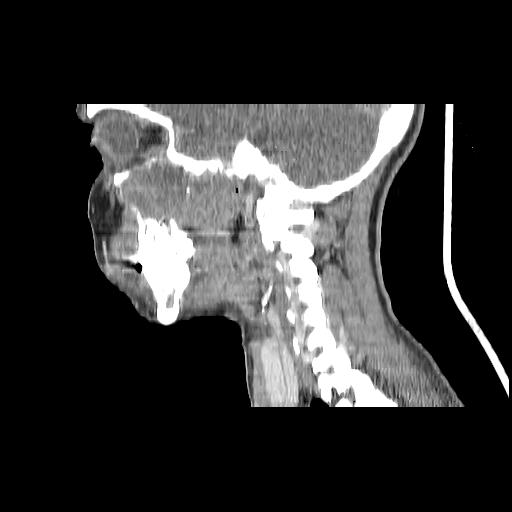 Carcinoma of the maxillary antrum (Radiopaedia 53805-59888 Sagittal C+ delayed 72).jpg