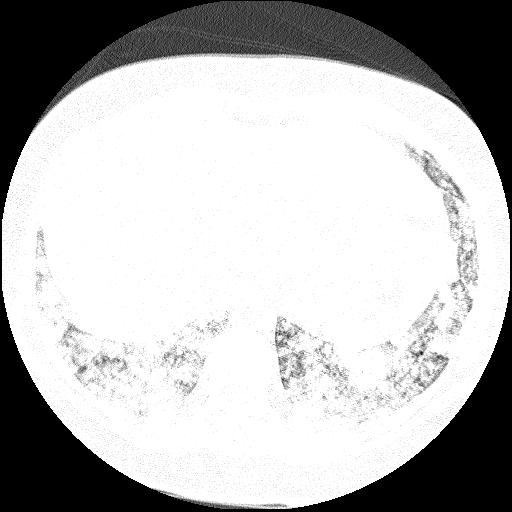 Cardiac angiosarcoma (Radiopaedia 66010-75181 Axial lung window 5).jpg