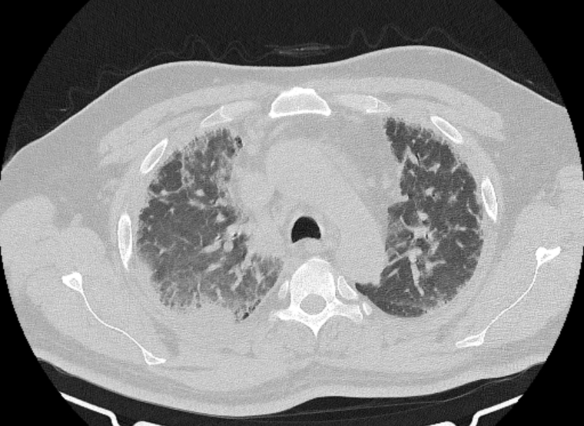Cardiogenic pulmonary edema (Radiopaedia 68180-77678 Axial lung window 25).jpg