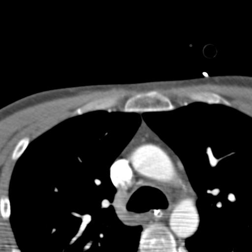 Carotid arterial dissection (Radiopaedia 30001-30548 B 1).jpg