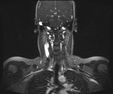 Carotid body tumor (Radiopaedia 12777-12912 MRA 43).jpg