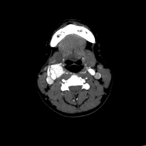 File:Carotid body tumor (Radiopaedia 39845-42300 B 32).jpg