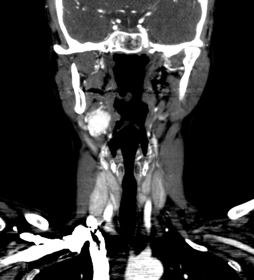 File:Carotid body tumor (Radiopaedia 39845-42300 C 12).jpg