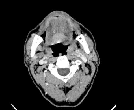 Carotid body tumor (Radiopaedia 61750-69757 Axial Post contrast 29).jpg