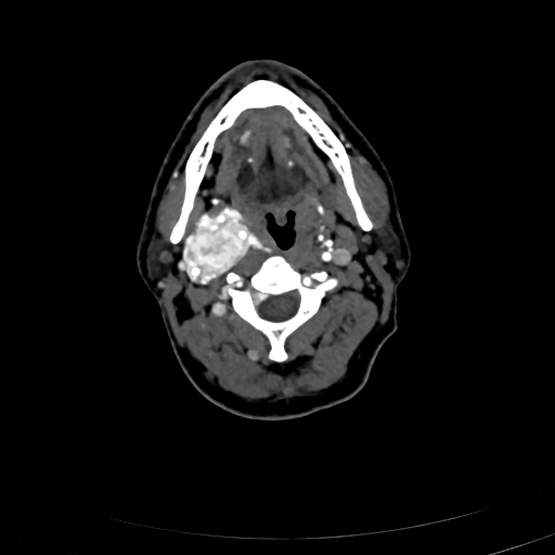 File:Carotid body tumor (Radiopaedia 83615-98727 A 49).jpg