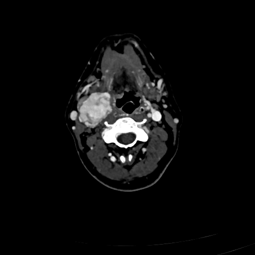 Carotid body tumor (Radiopaedia 83615-98727 D 57).jpg