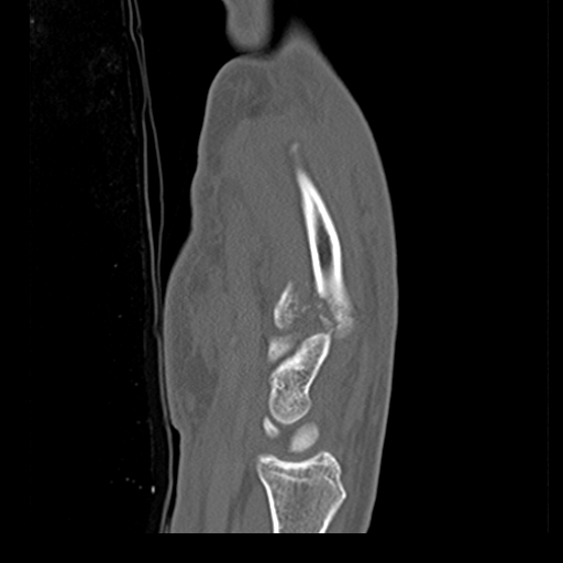 File:Carpo-metacarpal fracture-dislocations with hamatum split fracture (Radiopaedia 18482-18343 Sagittal bone window 13).jpg