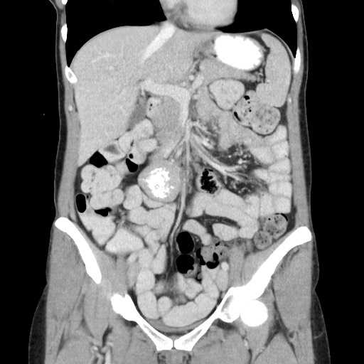 File:Castleman disease with fibrous pseudotumor in the abdomen (Radiopaedia 77296-89373 B 39).jpg