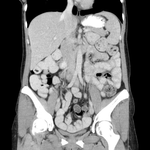 Castleman disease with fibrous pseudotumor in the abdomen (Radiopaedia 77296-89373 B 45).jpg