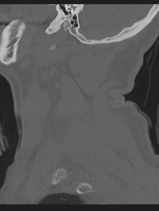 Cavernoma of cervical cord (Radiopaedia 50838-56346 Sagittal bone window 11).png