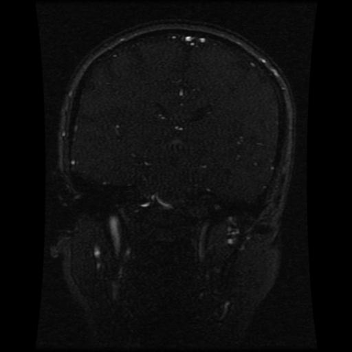 File:Cavernoma with developmental venous anomaly (Radiopaedia 22470-22507 MRV 69).jpg