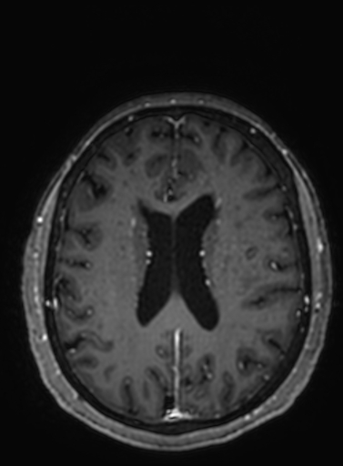 Cavernous hemangioma of the cerebellar falx (Radiopaedia 73025-83724 Axial T1 C+ 126).jpg