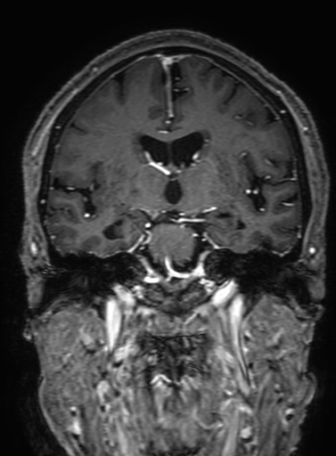 Cavernous hemangioma of the cerebellar falx (Radiopaedia 73025-83724 Coronal T1 C+ 187).jpg