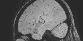 Cavernous hemangioma of the cerebellar falx (Radiopaedia 73025-83724 Sagittal BOLD 163).jpg