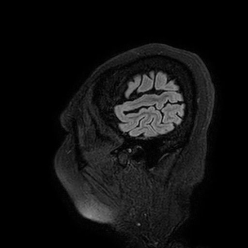 Cavernous hemangioma of the cerebellar falx (Radiopaedia 73025-83724 Sagittal FLAIR 8).jpg