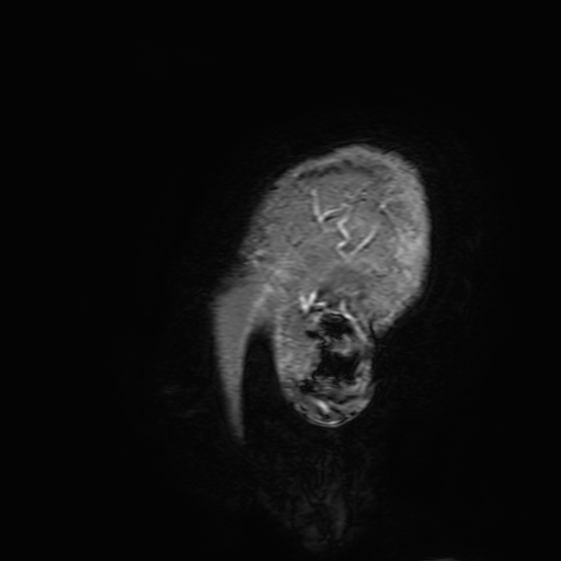 Cavernous hemangioma of the cerebellar falx (Radiopaedia 73025-83724 Sagittal T1 C+ 212).jpg