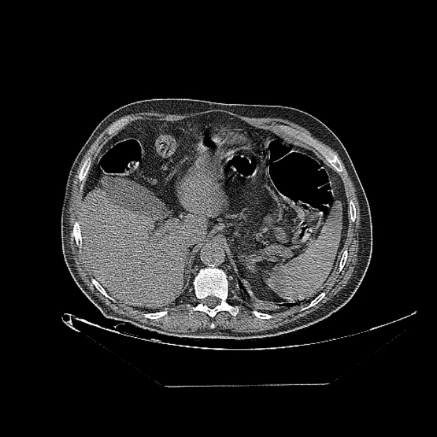 Cavitating bronchogenic carcinoma (Radiopaedia 44489-48162 Axial non-contrast 85).jpg