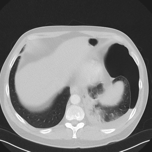 Cavitating pneumonia complicated by pneumothorax (Radiopaedia 48149-52994 Axial lung window 54).png
