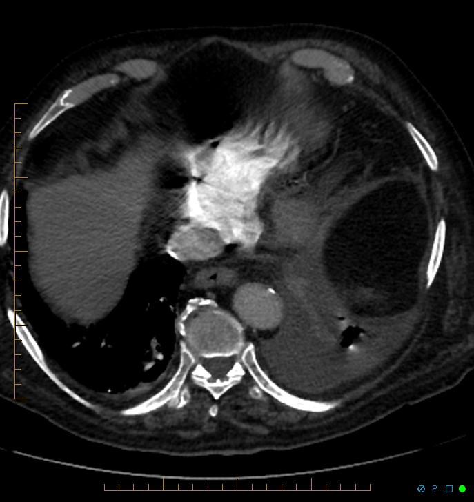 Cavitating pulmonary infarction (Radiopaedia 54634-60849 Axial C+ CTPA 66).jpg