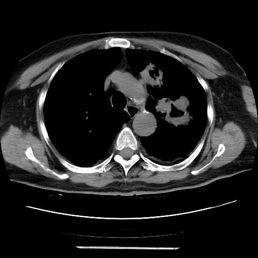 Cavitating pulmonary metastases (Radiopaedia 89545-106544 Axial non-contrast 18).jpg