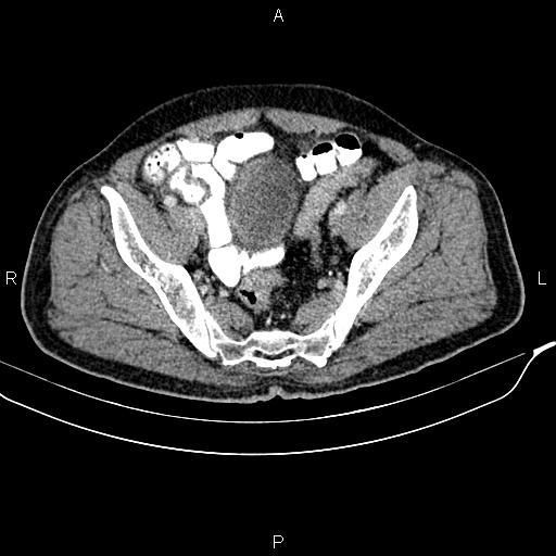 File:Cecal cancer with appendiceal mucocele (Radiopaedia 91080-108651 B 88).jpg