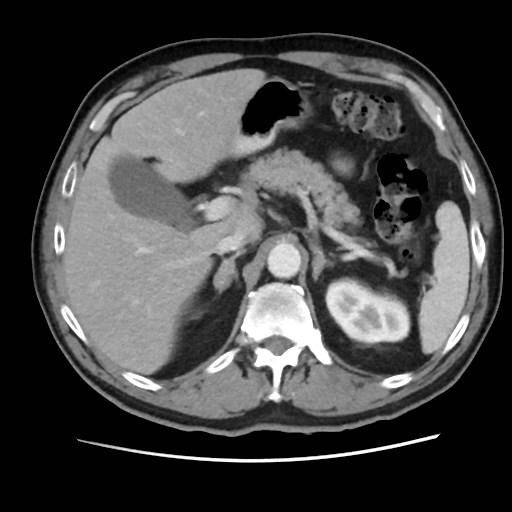 Cecal mass causing appendicitis (Radiopaedia 59207-66531 A 25).jpg