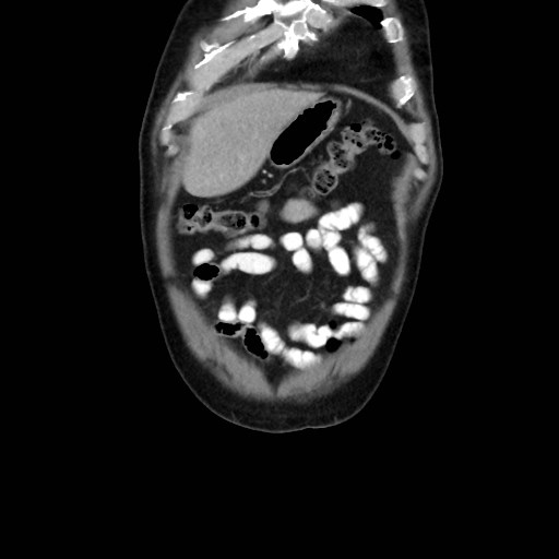 Cecal mass causing appendicitis (Radiopaedia 59207-66531 B 7).jpg