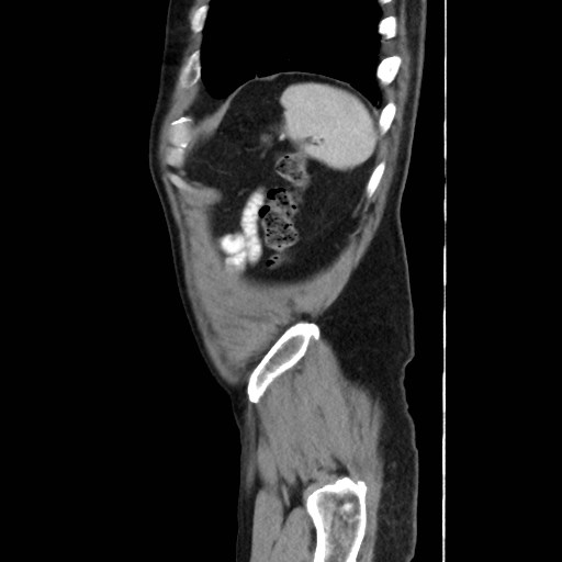 Cecal mass causing appendicitis (Radiopaedia 59207-66531 C 57).jpg