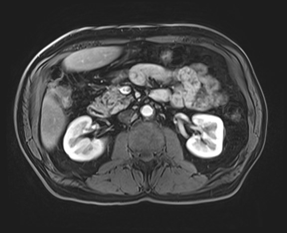 File:Cecal mass causing appendicitis (Radiopaedia 59207-66532 H 61).jpg